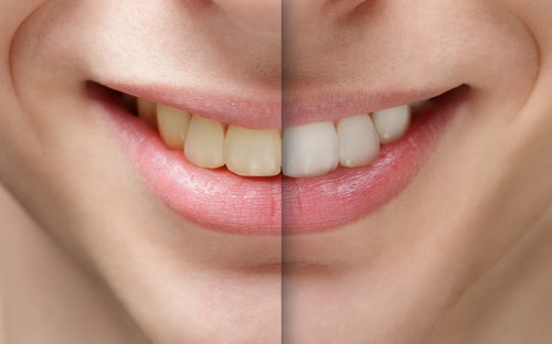 Before and after illustration of teeth whitening